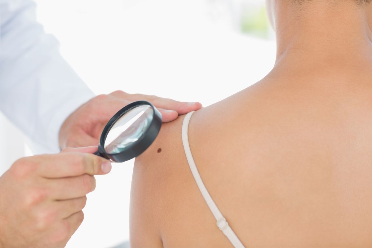 Causas del avance del melanoma
