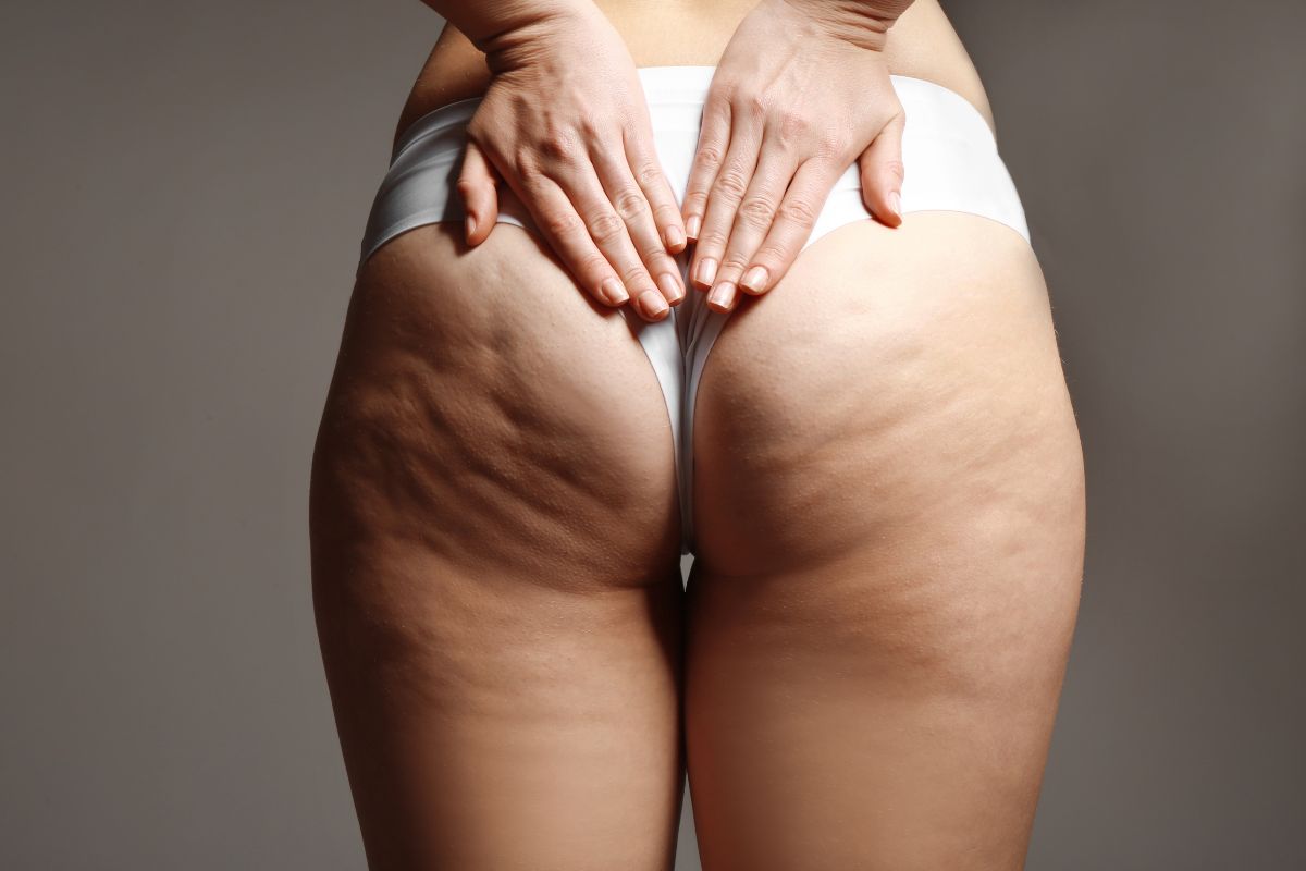 Mesoterapia y carboxiterapia