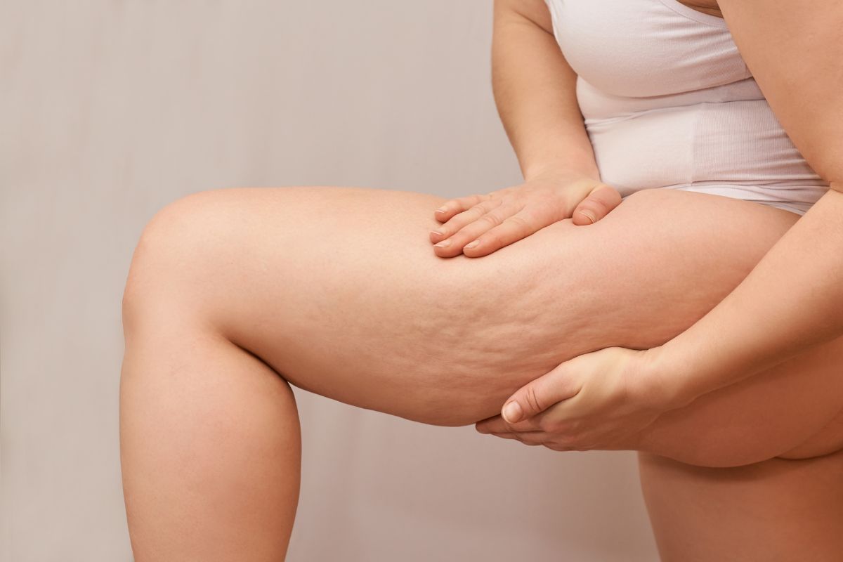 Principales problemas esteticos en los muslos