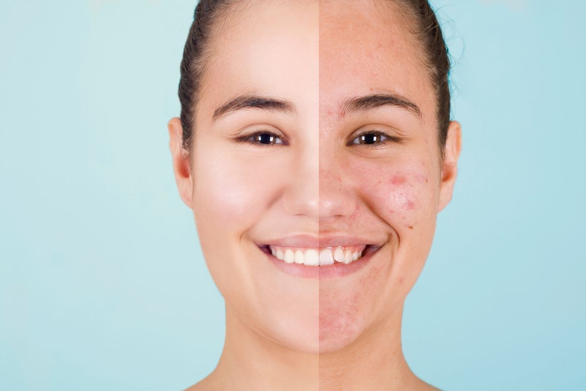 Soluciones de medicina estética para tratar el acné