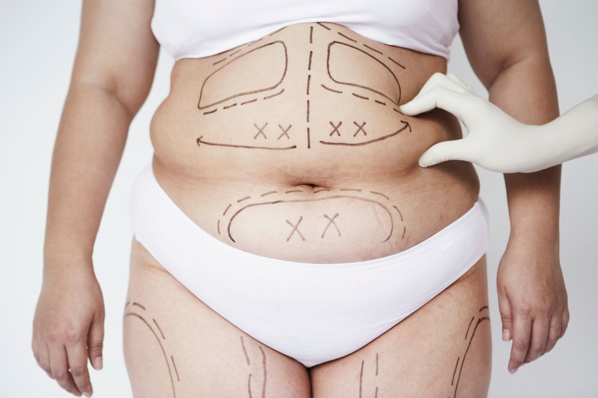 Intralipoterapia