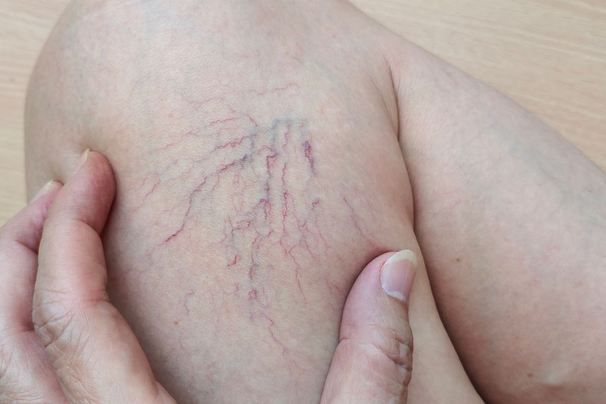 lesiones vasculares